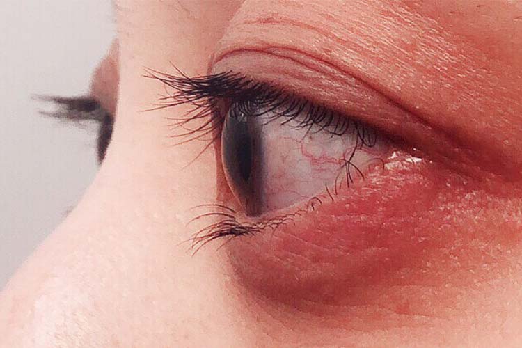 眼瞼炎がものもらいを引き起こすことはありますか、それともその逆ですか?